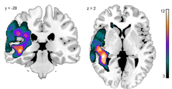 figure shows where individuals with Wernicke's aphasia have stroke damage. Hotter colours mean more people with Wernicke's aphasia had damage in that area.
