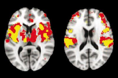 Brain scans of individuals that feel no pain