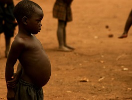 Malnourished child in Uganda