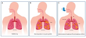 Figure 2 from Paper: shows the difference between lungs